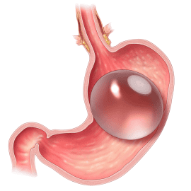 Orbera BIB System Intragastric 6 month Balloon